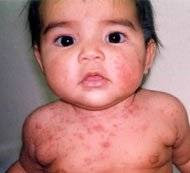Alergia a las fresas en bebes